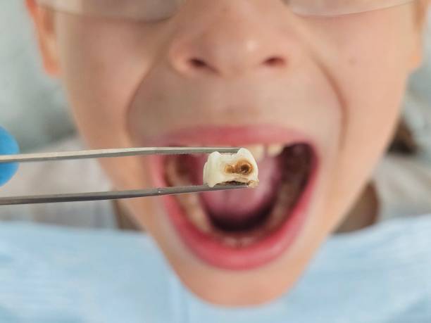 Best Emergency Treatment for Oral Infections in Orangevale, CA